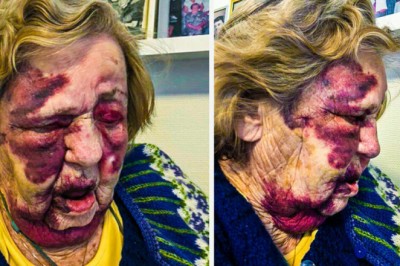 Legevakten ville ikke undersøke Anne Elisabeth (97): - Ble sinna